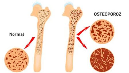 Spor ve Kemik Sağlığı: Düzenli Egzersizin Kemik Yoğunluğunu Artırma ve Osteoporoz Riskini Azaltma Potansiyeli