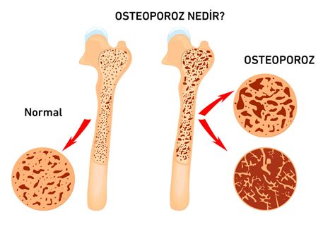 Spor ve Kemik Sağlığı: Düzenli Egzersizin Kemik Yoğunluğunu Artırma ve Osteoporoz Riskini Azaltma Potansiyeli