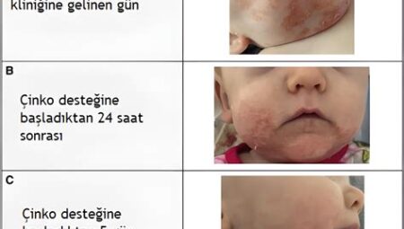 Cilt Altı Nem Eksikliği Belirtileri