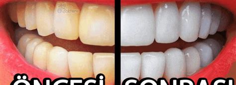 Diş Sağlığı İçin 5 Doğal Yöntem