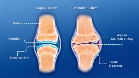 Eklem Sağlığı İçin Ne Yapmalı?
