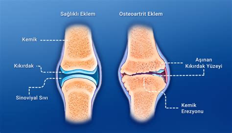 Eklem Sağlığı İçin Ne Yapmalı?