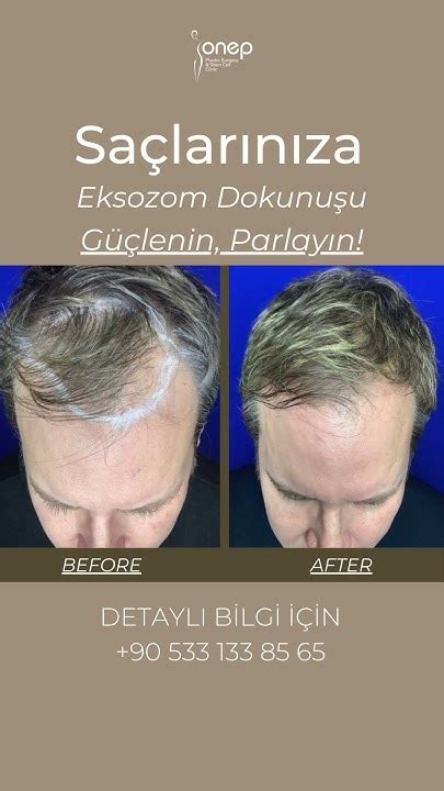 Saç Kaybına Karşı Günlük Önlemler